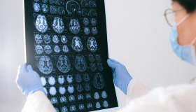 Un chip revolucionario podría cambiar la detección temprana del Alzheimer 