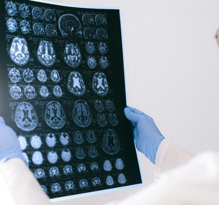 Un chip revolucionario podría cambiar la detección temprana del Alzheimer 